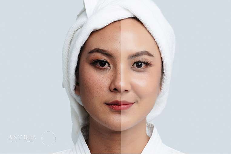 Melasma treatment singapore